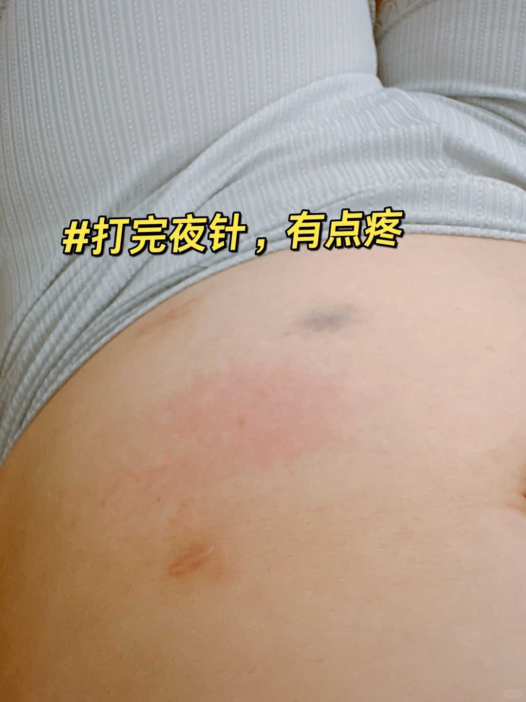 促排优势卵泡每天长多少mm有标准！附详细费用列表！ 专业试管代孕哪里有